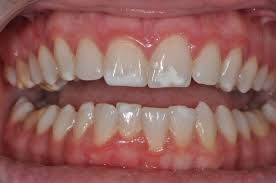 Get rid of white spots on teeth fast at home? Mi Paste Plus And White Spot Lesions Spear Education