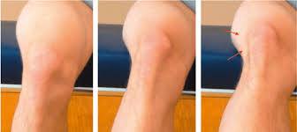 Image result for Patella Mobility Test