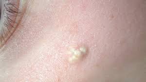 Home remedies for hard lumps under skin. Pilomatricoma Symptoms Causes Risks And Treatment