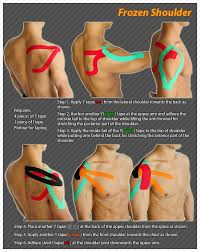 Kinesiology Taping Instructions For Frozen Shoulder Ktape Frozenshoulder Ares Kinesiology Taping Shoulder Exercises Physical Therapy Frozen Shoulder