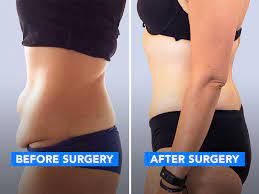 At vida, an average price for a lower body lift is of $5,600 usd, including the surgeon's fee, anesthesia, and medication. Results App Weight Loss Excess Skin Removal Surgery