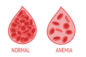 Steps that can be taken in Overcoming Anemia - EMC Healthcare - SAME