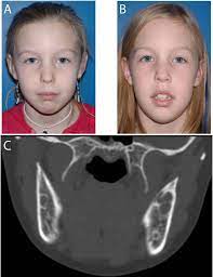 Medical definition of cherubism : Cherubism Best Clinical Practice Orphanet Journal Of Rare Diseases Full Text