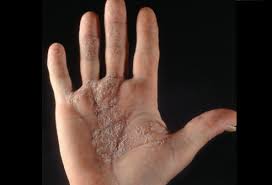 Psoriasis Vulgaris Palms Picture Image On Medicinenet Com