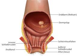 Ich habe seit wochen blut im stuhl und ab und an bleistiftstuhl und verstopfungen. Darmkrebs Fruherkennung Mit Stuhltest Und Darmspiegelung