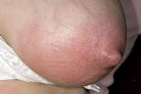 Mastite-Mammite solution naturelle