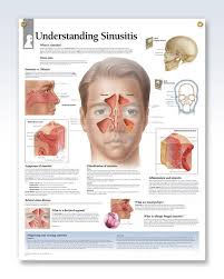 Understanding Sinusitis Chart 22x28 Sinus Infection
