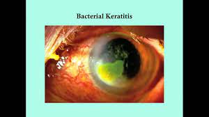 If the infection is mild, topical treatment with antibacterial drops may be enough. Keratitis Crash Medical Review Series Youtube