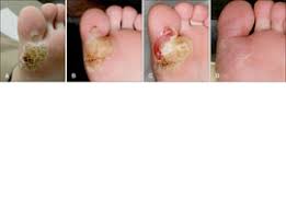 Treatment of recalcitrant plantar warts with imiquimod. Ad Annals Of Dermatology