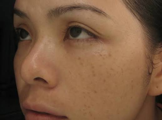 10 Cách trị nám, tàn nhang, đồi mồi lâu năm hiệu quả tại nhà