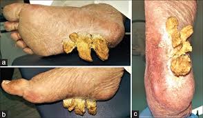 Image result for cornu cutaneum)