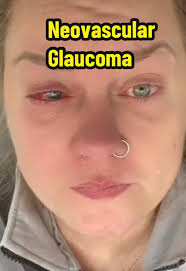 Glaucoma Eye Removal