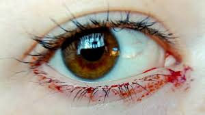 Haemolacria Causes And Treatment