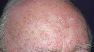 Skin cancer is by far the most common type of cancer. Skin Cancer Symptoms Pictures Types And More