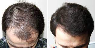 Sac Dokulmesini Onleyen Dogal Sampuan Tarifi Hair Beauty Advanced Hair Beauty