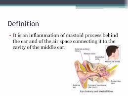 Image result for Mastoiditis