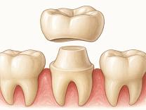 Dental Crowns/Cap product image