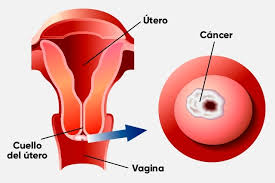 En algunas pacientes con cáncer de útero se practica una linfadenectomía, o disección de los ganglios linfáticos. 6 Sintomas De Cancer De Cuello Uterino Y Que Hacer Tua Saude