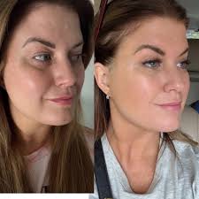 Med-spa owner shares experience with Neofiller