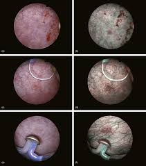 Can you drink coffee before a cystoscopy. Endoscopic Treatment Of Bladder Tumors Sciencedirect