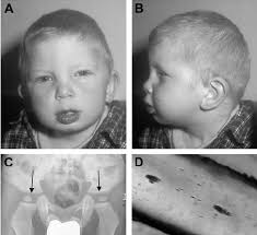 Dysplastic features of the patient. (A-B) Portrait of the patient...