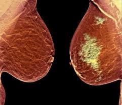 Unlocking the mysteries of cancer, l'utilisation du systme immunitaire dans la lutte contre le cancer paraissait encore une ide insolite. Percee De L Immunotherapie Dans Les Cancers Du Sein Triple Negatifs Le Quotidien Du Medecin