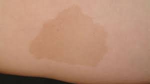 Mehr als 5 flecken > 25 mm macht einen m. Cafe Au Lait Fleck Altmeyers Enzyklopadie Fachbereich Dermatologie