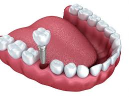 Have good oral and overall. Can I Get Dental Implants At A Dental School