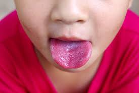 Causes infections like strep throat, acute rheumatic fever, scarlet fever, acute glomerulonephritis and necrotizing fasciitis. Scarlatina La Copii Tot Ce Trebuie SÄƒ È™tii Despre AceastÄƒ BoalÄƒ InfecÈ›ioasÄƒ