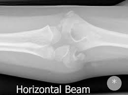 Resisted wrist extension with elbow fully extended. Elbow Injuries Rcemlearning