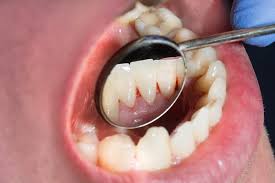 Image result for dental cancer