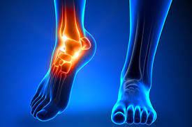But for the patients with sprains that do not heal over time with standard therapy, both the cause and next steps for treatment can be unclear. An Easier Recovery From Ankle Fracture Trauma Rothman Orthopaedic Institute