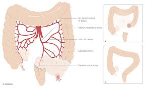 Image result for Enterostomy