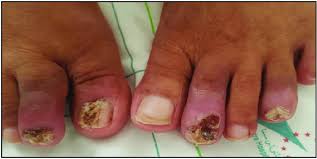 Image result for Paronychia feet