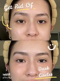 Get Rid of Dark Circles ⚫️