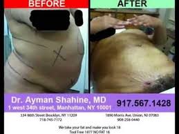 Pin On Plastic Surgery Tummy Tuck Breast Thighs
