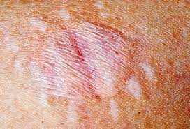 Brown recluse and black widow spider bites are medically significant in north america. Spider Bites How Dangerous Are They