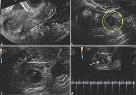• now cs:go has switched to a free model. Different Sonographic Faces Of Ectopic Pregnancy Journal Of Clinical Imaging Science