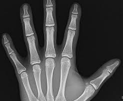 Image result for Hand Growth Plates
