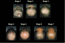 That something may be temporary and related to a natural, biological estrogen helps to keep hair follicles healthy; Male Androgenetic Alopecia Endotext Ncbi Bookshelf