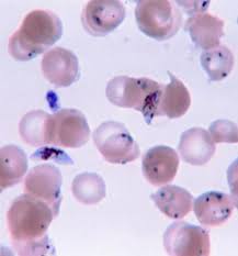 Image result for Malaria