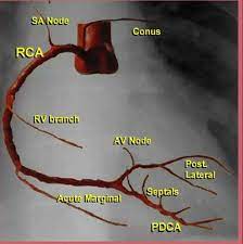 Simple Figure For Coronary Arteries Cardiac Catheterization Cath Lab Nursing Cardiac Sonography