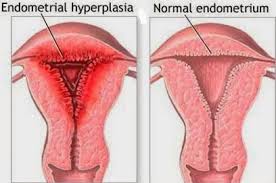 Hiperplasia endometrium atau penebalan dinding rahim adalah kondisi ketika lapisan sel dalam rahim menebal. Dinding Rahim Menebal Tidak Normal Kaskus