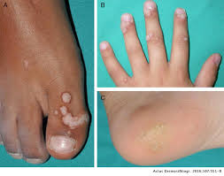 A color guide to diagnosis and therapy. Treatment Of Warts In Children An Update Actas Dermo Sifiliograficas