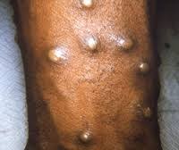 This is the first time. Monkeypox France Pdf Ppt Case Reports Symptoms Treatment