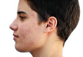 Hasil gambar untuk Acne
