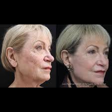 Lower Facelift + Neck Lift with Fat Transfer, Lip Lift, and TCA Peel ✨ Our  gorgeous patient is 7 months post op here and looks so refreshed. She's  incredibly happy with her results!