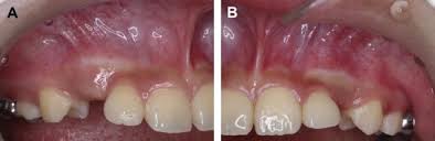 If the crown is positioned mesial to the lateral incisor, a closed technique for the pataltal eruption of canine. Surgical Considerations And Management Of Bilateral Labially Impacted Canines Sciencedirect