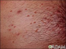 Image result for skin rash acute hiv infection