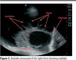 Send aspirated fluid for cytology. Figure 3 From Multiloculated Pleural Effusion Detected By Ultrasound Only In A Critically Ill Patient Semantic Scholar
